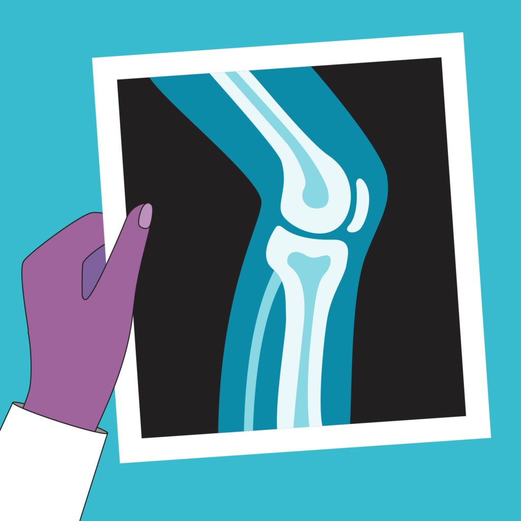 A hand holds an x-ray of a knee
